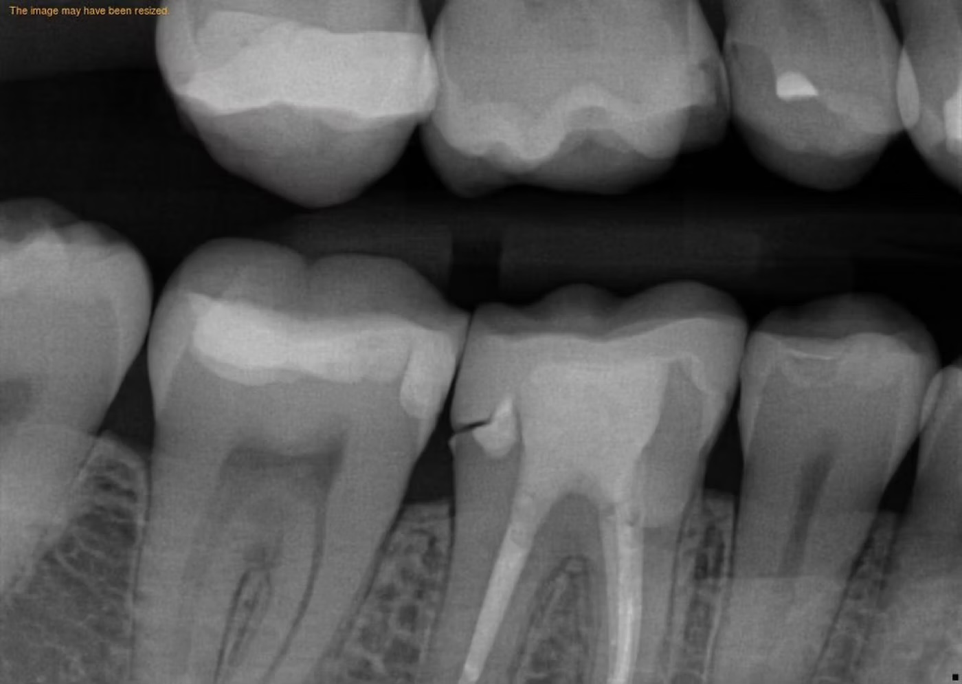 Dental X-ray of the lower molars.